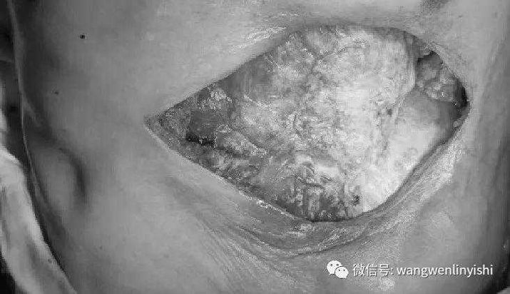 The chest wall defect was repaired using Matrix RIBs.