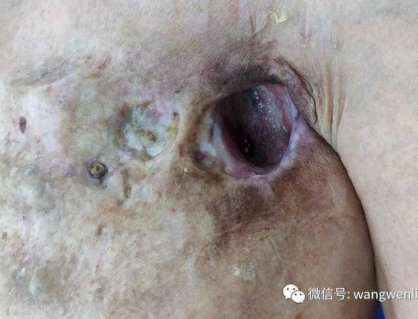 Defect in the left anterior chest wall