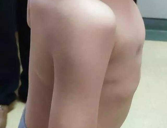 4岁直背综合征合并胸廓畸形患儿的手术