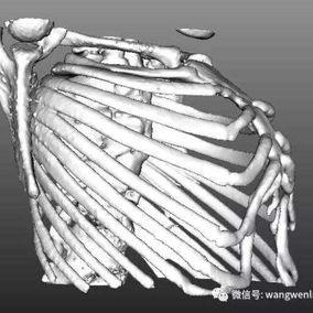 三维图像显示前胸壁前突