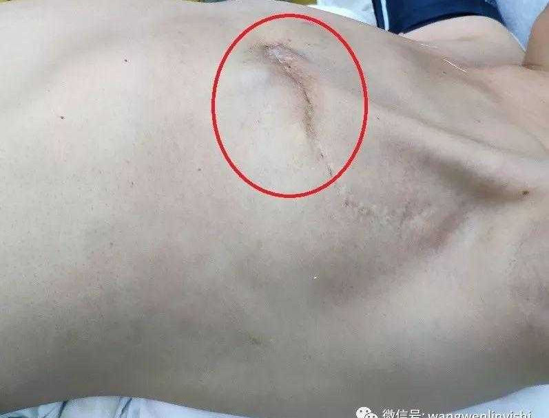 中年女性患者的胸壁肿瘤切除与胸壁重建手术