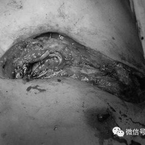 彻底清除坏死结构