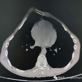 CT image