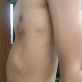 Typical groove-like depression is present, with an old surgical scar visible on the left chest wall.