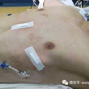 Postoperative chest wall appaerance