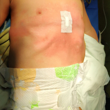 After surgery