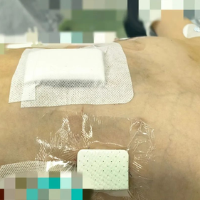 The chest wall appearance returned to normal after the surgery