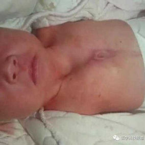 出生一月时的胸壁，上胸壁凹陷明显，吸气时加重