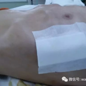 术后胸壁外观
