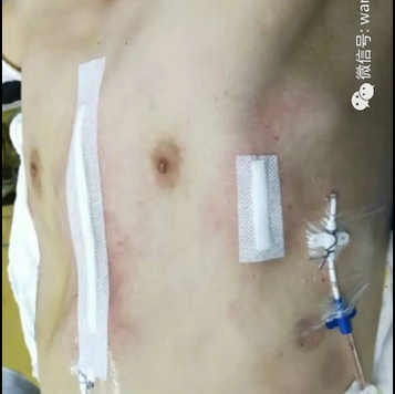 术后胸壁外观