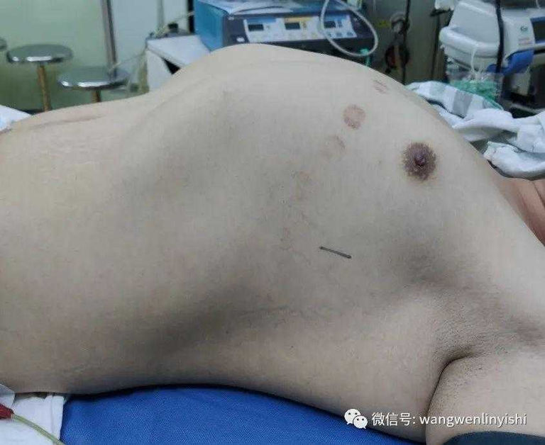 重度桶状胸