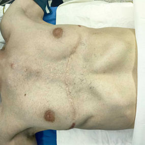 胸壁外观严重异常，其表面有多条陈旧性手术疤痕，正中有大面积凹陷，且两侧有隆起的假体