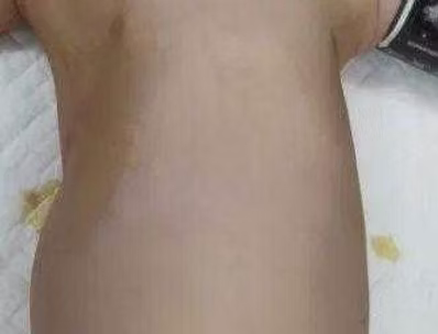 9月龄窒息性胸廓发育不良患儿的手术