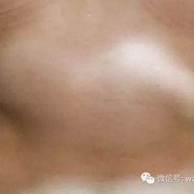 左侧肋弓前突，右侧低平，双侧凹陷