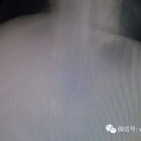 两侧胸壁均有明显凹陷