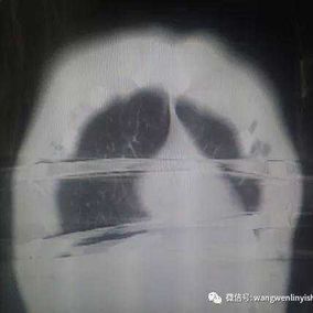术后CT检查（冠状面）：钢板的位置