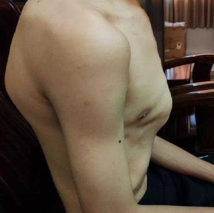 术前的胸廓外观