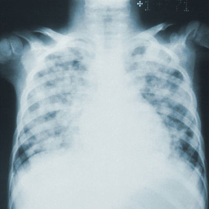 全球首部胸壁外科专业期刊 《胸壁外科杂志》（Journal of Chest Wall Surgery）正式上线
