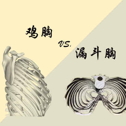 漏斗胸与鸡胸：有哪些不同？